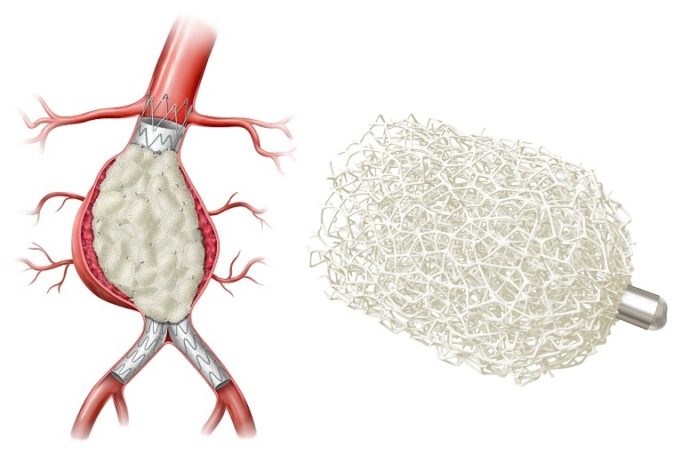 First patient enrolled in Shape Memory Medical’s AAA-SHAPE Netherlands study