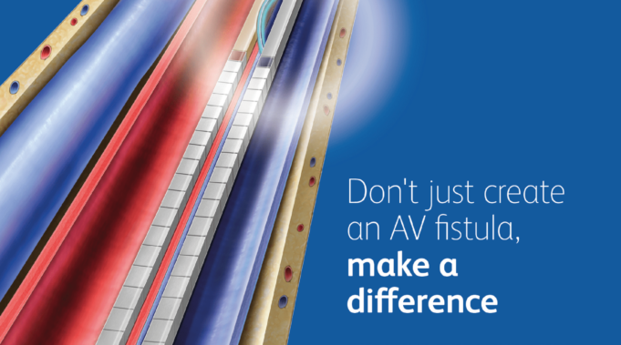 The WavelinQ™ EndoAVF System takes an innovative approach in creating endovascular AV fistulas for dialysis patients