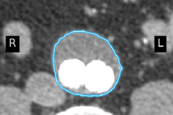 Researchers create novel solution for automatic measurement of maximum aortic diameter
