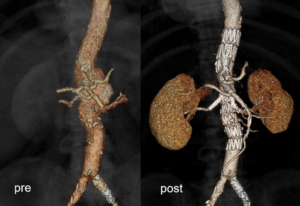 bridging stent