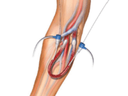 Aspirex