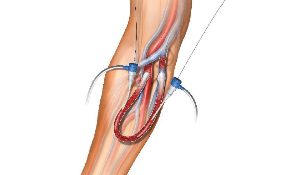 Case report: Aspirex™S enables treatment of thrombosed prosthetic arteriovenous grafts Aspirex