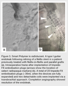 Shape Memory Polymer: A New Solution for AAA Endoleak Management