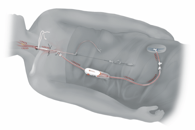 Silk Road to evaluate TCAR in standard surgical risk patients with ROADSTER 3 study