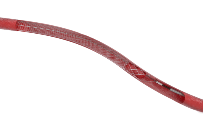 ClotTriever deemed a “game-changer” in deep vein thrombosis treatment