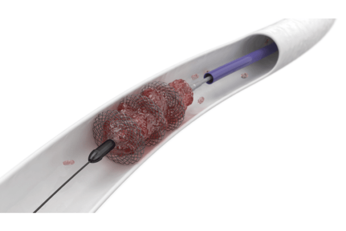 New mechanical thrombectomy systems unlock possibilities for the treatment of venous thromboembolism