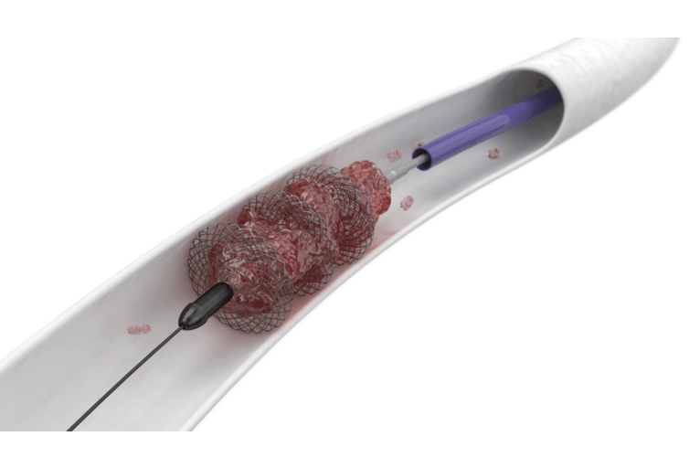 New mechanical thrombectomy systems unlock possibilities for the