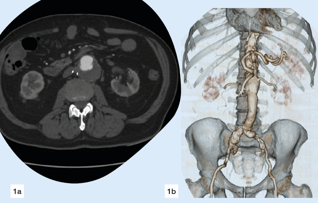 Shockwave Dissection Shockwave IVL: The last piece of the puzzle to overcome the challenge ...