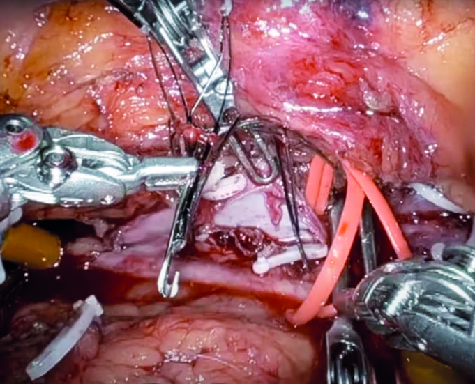 Robotic surgery: “We have missed the boat on this,” says Houston vascular chief