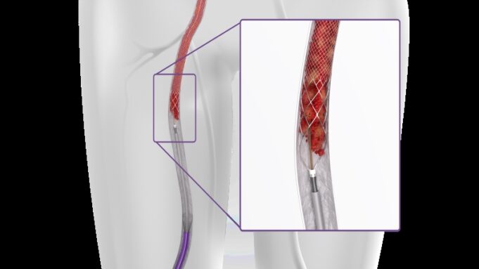ClotTriever “makes fast, safe and efficient thrombectomy possible”