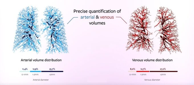 Artificial intelligence could enable life-saving early diagnosis and advance the treatment of pulmonary hypertension