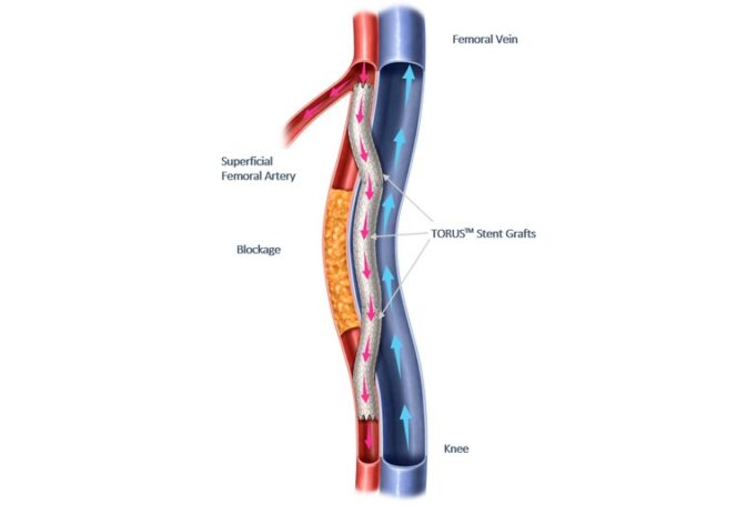 Two-year DETOUR2 study results presented at VAM 2023 detour system