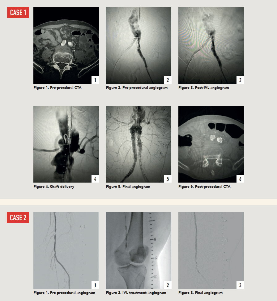 Shockwave Peripheral Intravascular Lithotripsy Toolkit Expands