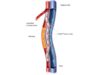 Three-year DETOUR2 results demonstrate sustained limb preservation in complex SFA disease Detour