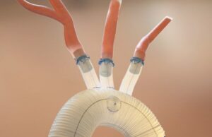 Aquedeon Medical receives US FDA approval to expand clinical trial of Duett vascular graft system