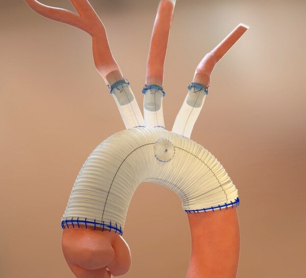 Aquedeon Medical receives US FDA approval to expand clinical trial of Duett vascular graft system