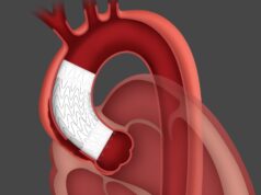 First patient treated in ARISE II study of Gore ascending stent graft