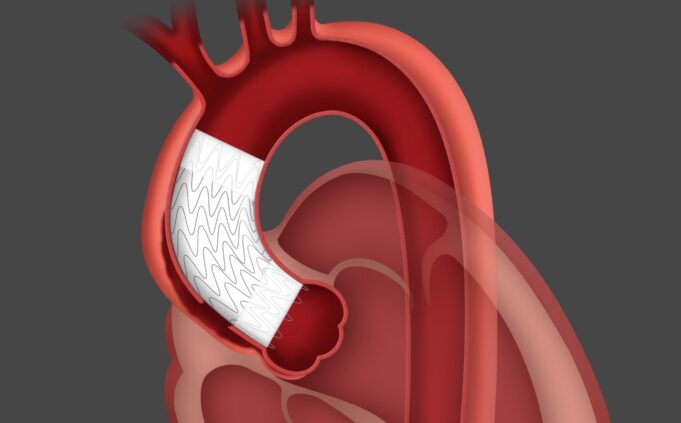 First patient treated in ARISE II study of Gore ascending stent graft