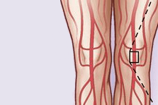 Mainstream media dig deeper into atherectomy use in the USA, SVS responds