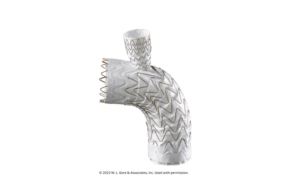 Gore announces first European implantation of Gore Tag thoracic branch endoprosthesis