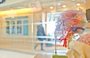 Measuring plaque inflammation via SCAIL scores may improve carotid stenosis risk stratification