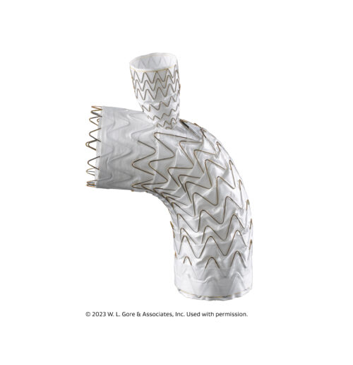 Gore announces first European implantation of Gore Tag thoracic branch endoprosthesis Vascular