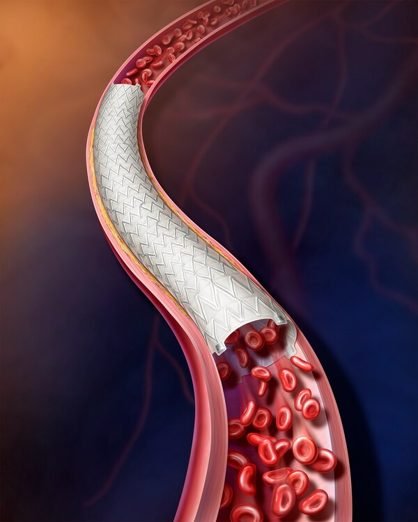 BD announces first patient enrolled in PAD vascular covered stent trial ...