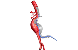 Terumo Aortic receives prestigious King’s Award for Innovation