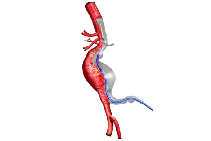 Terumo Aortic receives prestigious King’s Award for Innovation