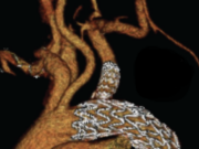 New frontiers in LSA preservation: Dedicated symposium at CX 2024 spotlights the GORE® TAG® Thoracic Branch Endoprosthesis LSA
