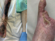 Utilisation of Novosorb® Biodegradable Temporising Matrix in a patient with CLTI and extensive tissue loss