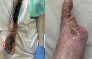 Utilisation of Novosorb® Biodegradable Temporising Matrix in a patient with CLTI and extensive tissue loss