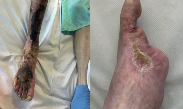 Utilisation of Novosorb® Biodegradable Temporising Matrix in a patient with CLTI and extensive tissue loss