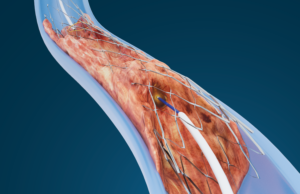 Baylis Medical Technologies announces first commercial use of PowerWire Pro for in-stent restenosis PowerWire