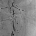 Cannulation of the fenestrations