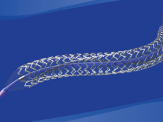 iVascular announces first data from BARISTA trial of Restorer BMS in iliac artery treatment