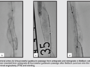 Chronic total occlusions: Do we need to update the crossing algorithm?