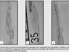 Chronic total occlusions: Do we need to update the crossing algorithm?