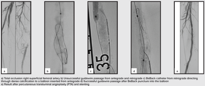 Chronic total occlusions: Do we need to update the crossing algorithm?