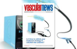 Is it time to rethink your treatment strategy in calcified iliac arteries? L6