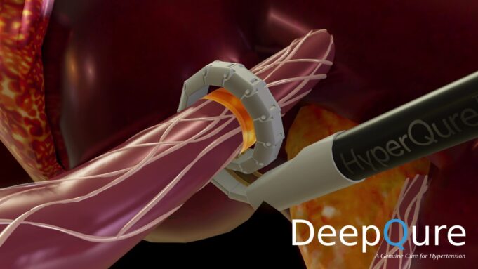 DeepQure advances clinical trials of its HyperQure extravascular renal denervation system
