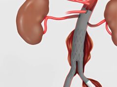 Cook Medical announces US launch of Zenith iliac branch device