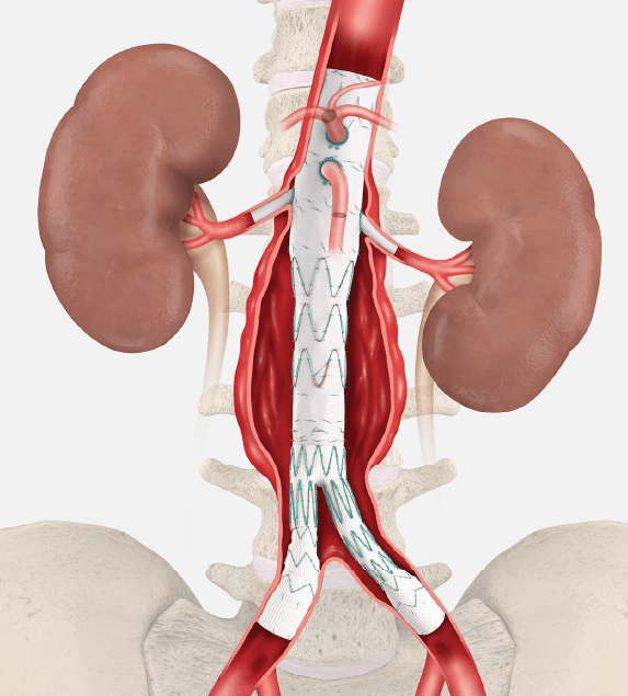 Final patient treated in Cook’s Zenith Fenestrated+ endovascular graft clinical study