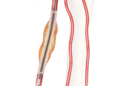 US FDA grants approval for IDE study on Cook’s Advance Evero 18 everolimus-coated balloon catheter
