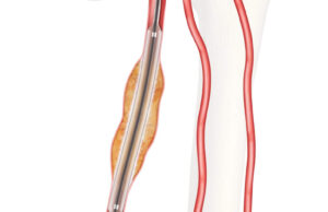 US FDA grants approval for IDE study on Cook’s Advance Evero 18 everolimus-coated balloon catheter