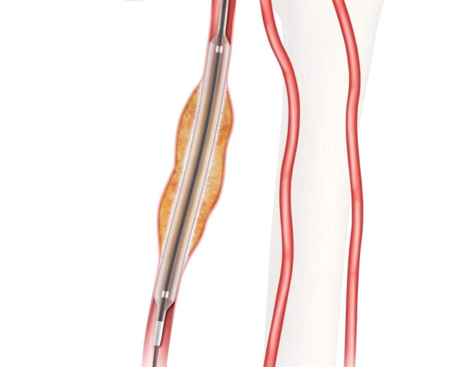 US FDA grants approval for IDE study on Cook’s Advance Evero 18 everolimus-coated balloon catheter