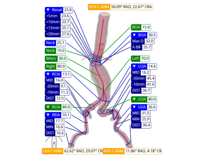 ViTAA Medical announces US FDA 510(k) clearance for aortic planning platform