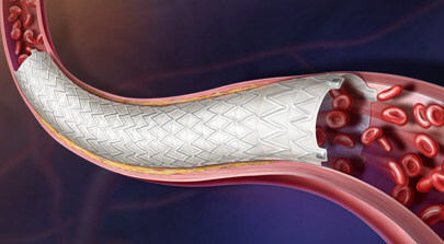 BD receives CE mark for Revello vascular covered stent