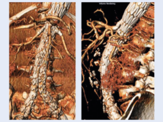 Midterm, real-world data strengthen use of Gore Viabahn VBX balloon-expandable endoprosthesis for F/BEVAR
