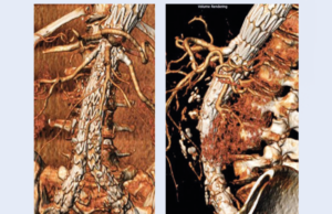 Midterm, real-world data strengthen use of Gore Viabahn VBX balloon-expandable endoprosthesis for F/BEVAR